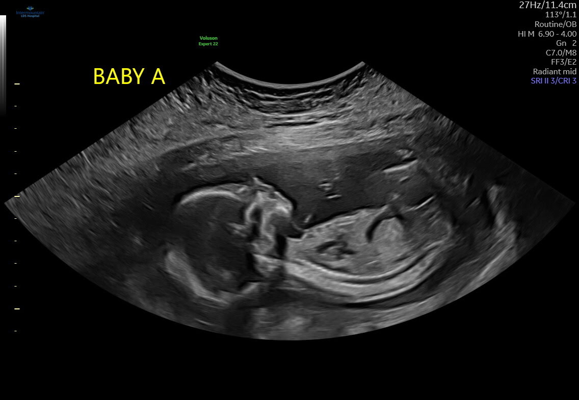 Baby A Ultrasound
