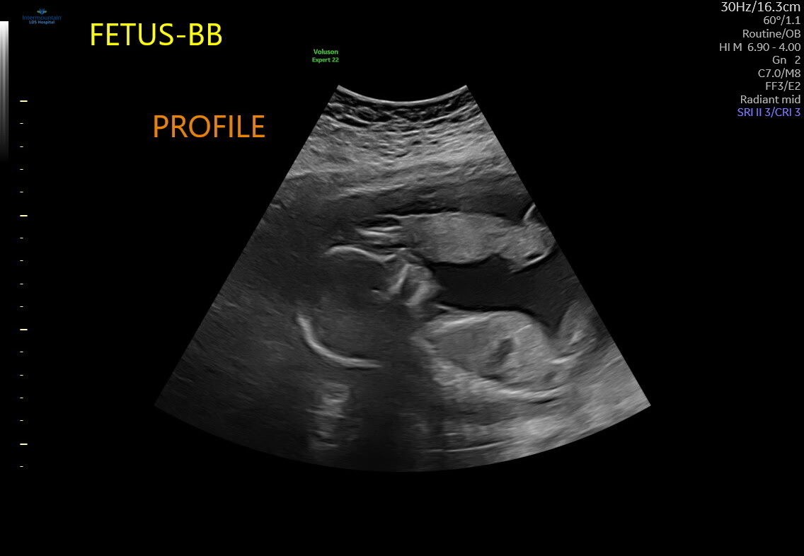 Baby B Ultrasound